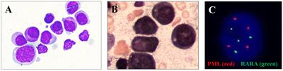 Case Report: Identification of a novel LYN::LINC01900 transcript with promyelocytic phenotype and TP53 mutation in acute myeloid leukemia
